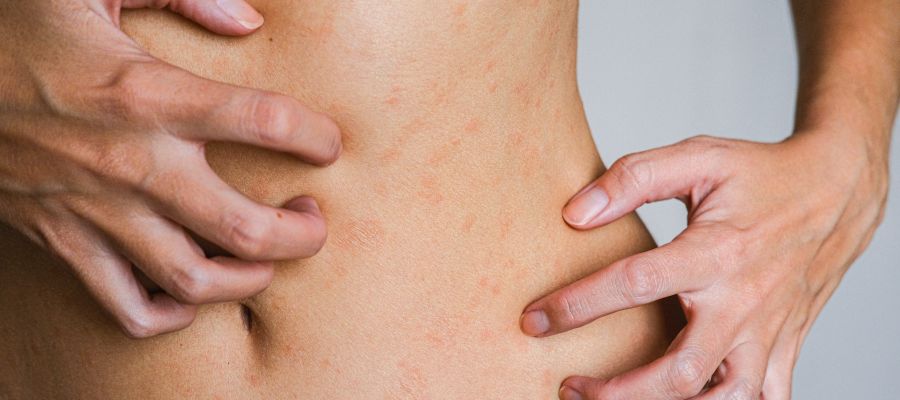 Bedbugs Attack: Tips and Treatment Options Near Me in Columbus, OH Bedbugs Attack: Tips and Treatment Options Near Me in Columbus, OH