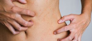 Bedbugs Attack: Tips and Treatment Options Near Me in Columbus, OH Bedbugs Attack: Tips and Treatment Options Near Me in Columbus, OH