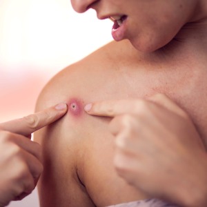 Abscess Draining Treatment Near Me in Riverview FL