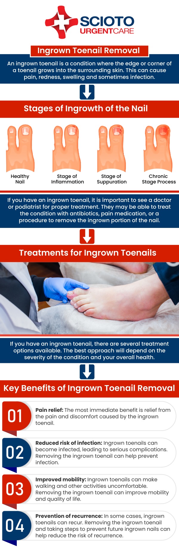 Common questions asked by patients: What is an ingrown toenail? What are the symptoms of an ingrown toenail? What causes ingrown toenail? How are ingrown toenails treated? How can I prevent an ingrown toenail? An ingrown toenail occurs when the edge of the nail grows into the surrounding skin, causing pain, swelling, and sometimes infection. It often affects the big toe and can make walking uncomfortable. At Scioto Urgent Care, board-certified doctor Dr. William Rothe, M.D., provides effective treatment to relieve symptoms and prevent complications. For more information, contact us now or book an appointment. We are conveniently located at 4760 Sawmill Road Columbus, OH 43235. We serve patients from Columbus OH, Dublin OH, Upper Arlington OH, Hilliard OH, Worthington OH, and surrounding areas. Common questions asked by patients: What is an ingrown toenail? What are the symptoms of an ingrown toenail? What causes ingrown toenail? How are ingrown toenails treated? How can I prevent an ingrown toenail?
An ingrown toenail occurs when the edge of the nail grows into the surrounding skin, causing pain, swelling, and sometimes infection. It often affects the big toe and can make walking uncomfortable. At Scioto Urgent Care, board-certified doctor Dr. William Rothe, M.D., provides effective treatment to relieve symptoms and prevent complications. For more information, contact us now or book an appointment. We are conveniently located at 4760 Sawmill Road Columbus, OH 43235. We serve patients from Columbus OH, Dublin OH, Upper Arlington OH, Hilliard OH, Worthington OH, and surrounding areas.
