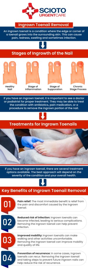 Common questions asked by patients: What is an ingrown toenail? What are the symptoms of an ingrown toenail? What causes ingrown toenail? How are ingrown toenails treated? How can I prevent an ingrown toenail? An ingrown toenail occurs when the edge of the nail grows into the surrounding skin, causing pain, swelling, and sometimes infection. It often affects the big toe and can make walking uncomfortable. At Scioto Urgent Care, board-certified doctor Dr. William Rothe, M.D., provides effective treatment to relieve symptoms and prevent complications. For more information, contact us now or book an appointment. We are conveniently located at 4760 Sawmill Road Columbus, OH 43235. We serve patients from Columbus OH, Dublin OH, Upper Arlington OH, Hilliard OH, Worthington OH, and surrounding areas. Common questions asked by patients: What is an ingrown toenail? What are the symptoms of an ingrown toenail? What causes ingrown toenail? How are ingrown toenails treated? How can I prevent an ingrown toenail?
An ingrown toenail occurs when the edge of the nail grows into the surrounding skin, causing pain, swelling, and sometimes infection. It often affects the big toe and can make walking uncomfortable. At Scioto Urgent Care, board-certified doctor Dr. William Rothe, M.D., provides effective treatment to relieve symptoms and prevent complications. For more information, contact us now or book an appointment. We are conveniently located at 4760 Sawmill Road Columbus, OH 43235. We serve patients from Columbus OH, Dublin OH, Upper Arlington OH, Hilliard OH, Worthington OH, and surrounding areas.