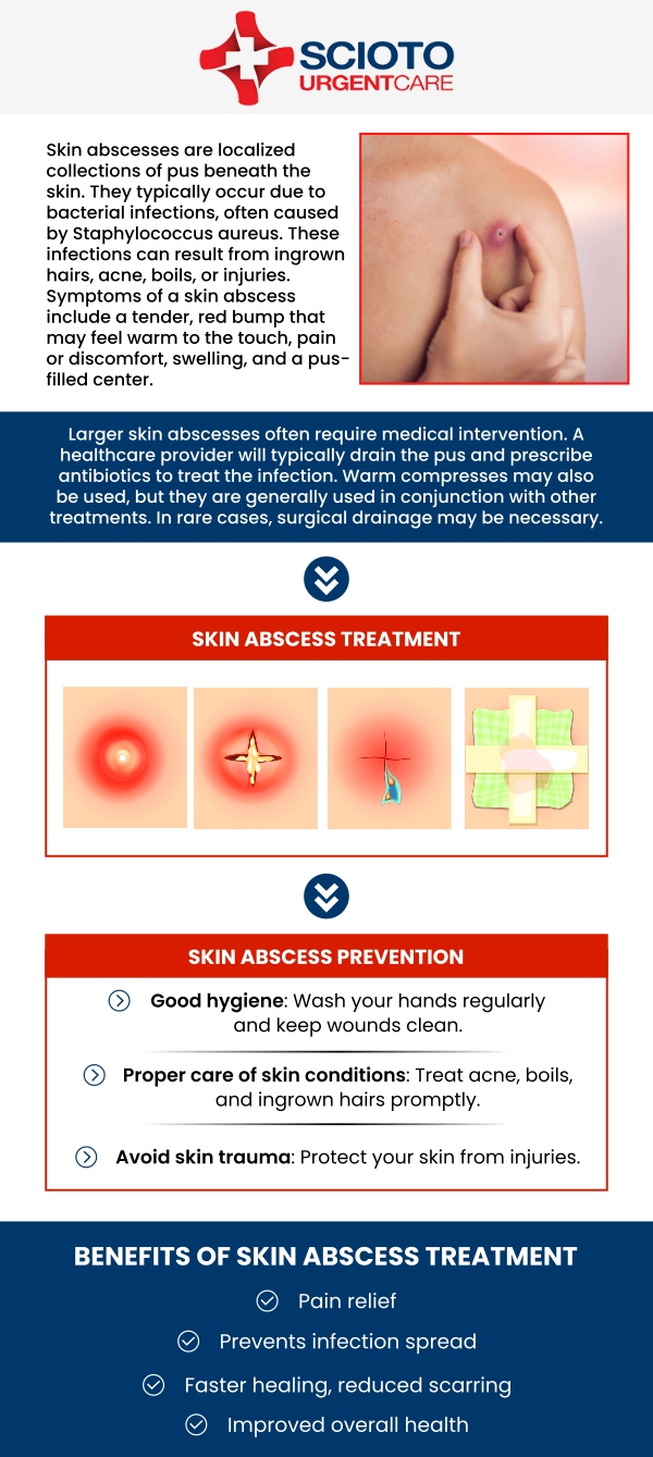 Common questions asked by patients: What is an abscess? At what point does an abscess need to be drained? How long does a drained abscess take to heal? Where can I get treatment for an abscess? Abscess drainage treatment in Columbus, OH, is available at Scioto Urgent Care with Dr. William Rothe, M.D. If you're experiencing an abscess, Dr. Rothe provides quick, effective care to drain the infection and promote healing. Using proper sterile techniques, he ensures the area is treated safely, minimizing complications and discomfort. For more information, contact us now or book an appointment. We are conveniently located at 4760 Sawmill Road Columbus, OH 43235. We serve patients from Columbus OH, Dublin OH, Upper Arlington OH, Hilliard OH, Worthington OH, and surrounding areas. Common questions asked by patients: What is an abscess? At what point does an abscess need to be drained? How long does a drained abscess take to heal? Where can I get treatment for an abscess?
Abscess drainage treatment in Columbus, OH, is available at Scioto Urgent Care with Dr. William Rothe, M.D. If you're experiencing an abscess, Dr. Rothe provides quick, effective care to drain the infection and promote healing. Using proper sterile techniques, he ensures the area is treated safely, minimizing complications and discomfort. For more information, contact us now or book an appointment. We are conveniently located at 4760 Sawmill Road Columbus, OH 43235. We serve patients from Columbus OH, Dublin OH, Upper Arlington OH, Hilliard OH, Worthington OH, and surrounding areas.