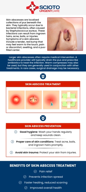 Common questions asked by patients: What is an abscess? At what point does an abscess need to be drained? How long does a drained abscess take to heal? Where can I get treatment for an abscess? Abscess drainage treatment in Columbus, OH, is available at Scioto Urgent Care with Dr. William Rothe, M.D. If you're experiencing an abscess, Dr. Rothe provides quick, effective care to drain the infection and promote healing. Using proper sterile techniques, he ensures the area is treated safely, minimizing complications and discomfort. For more information, contact us now or book an appointment. We are conveniently located at 4760 Sawmill Road Columbus, OH 43235. We serve patients from Columbus OH, Dublin OH, Upper Arlington OH, Hilliard OH, Worthington OH, and surrounding areas. Common questions asked by patients: What is an abscess? At what point does an abscess need to be drained? How long does a drained abscess take to heal? Where can I get treatment for an abscess?
Abscess drainage treatment in Columbus, OH, is available at Scioto Urgent Care with Dr. William Rothe, M.D. If you're experiencing an abscess, Dr. Rothe provides quick, effective care to drain the infection and promote healing. Using proper sterile techniques, he ensures the area is treated safely, minimizing complications and discomfort. For more information, contact us now or book an appointment. We are conveniently located at 4760 Sawmill Road Columbus, OH 43235. We serve patients from Columbus OH, Dublin OH, Upper Arlington OH, Hilliard OH, Worthington OH, and surrounding areas.