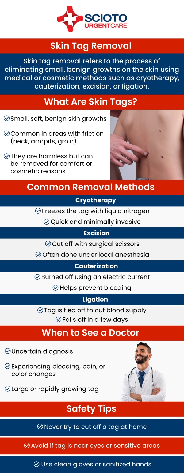 Common questions asked by patients: What are skin tags? What causes skin tags? How can skin tags be removed? Is skin tag removal painful? How long does it take to recover from skin tag removal? Does insurance cover skin tag removal? Skin tag removal is a simple procedure that can be done through various methods. The process is quick and typically involves minimal pain, with most patients experiencing a short recovery time. Dr. William Rothe, M.D., at Scioto Urgent Care ensures safe and effective removal while reducing the risk of complications. For more information, contact us now or book an appointment. We are conveniently located at 4760 Sawmill Road Columbus, OH 43235. We serve patients from Columbus OH, Dublin OH, Upper Arlington OH, Hilliard OH, Worthington OH, and surrounding areas. Common questions asked by patients: What are skin tags? What causes skin tags? How can skin tags be removed? Is skin tag removal painful? How long does it take to recover from skin tag removal? Does insurance cover skin tag removal?
Skin tag removal is a simple procedure that can be done through various methods. The process is quick and typically involves minimal pain, with most patients experiencing a short recovery time. Dr. William Rothe, M.D., at Scioto Urgent Care ensures safe and effective removal while reducing the risk of complications. For more information, contact us now or book an appointment. We are conveniently located at 4760 Sawmill Road Columbus, OH 43235. We serve patients from Columbus OH, Dublin OH, Upper Arlington OH, Hilliard OH, Worthington OH, and surrounding areas.