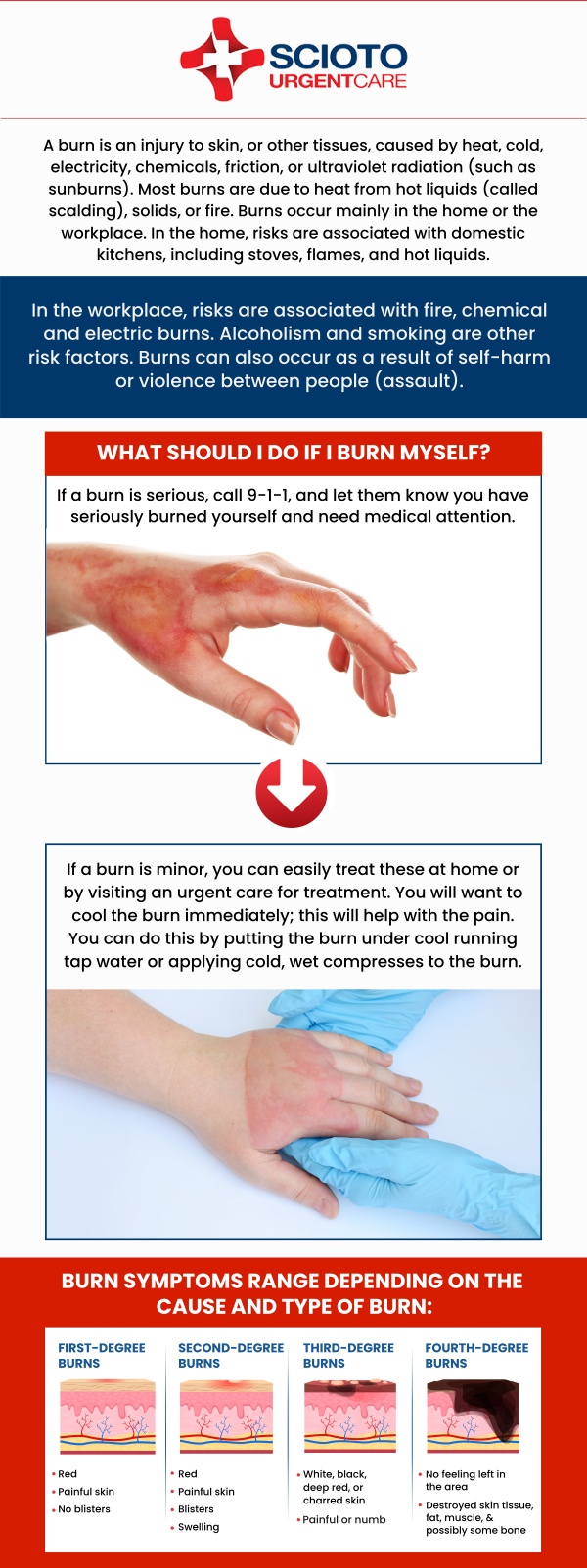 Common questions asked by patients: What is a minor burn? How should minor burns be treated? What are the symptoms of a minor burn? How long does it take to heal from minor burns? What are the different types of minor burns?
At Scioto Urgent Care, we specialize in treating minor burns, such as those caused by hot fluids or stove contact. Our experienced team, led by Dr. William Rothe, M.D., provides prompt and effective care for these injuries. For more information, contact us now or book an appointment. We are conveniently located at 4760 Sawmill Road Columbus, OH 43235. We serve patients from Columbus OH, Dublin OH, Upper Arlington OH, Hilliard OH, Worthington OH, and surrounding areas.